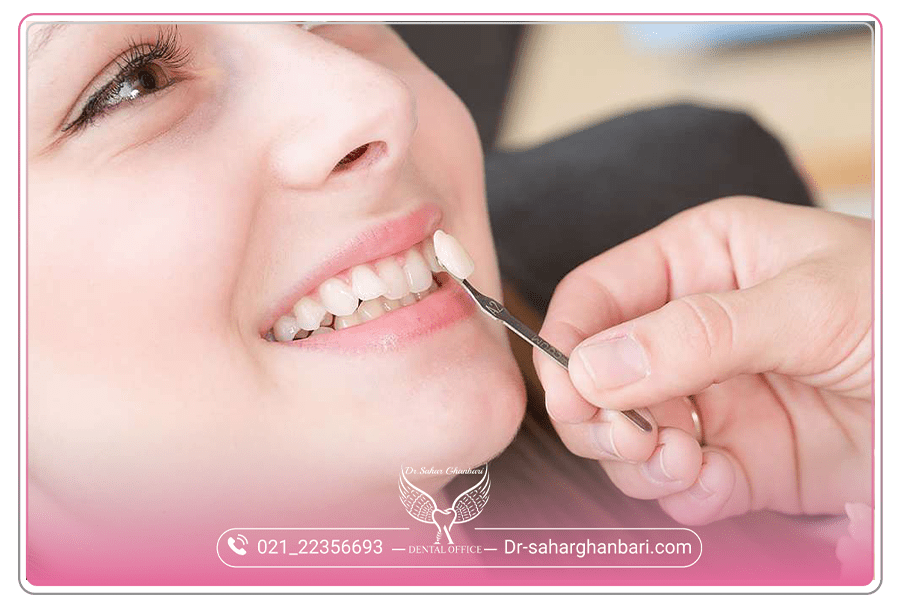 لمینت چگونه انجام می‌‌شود