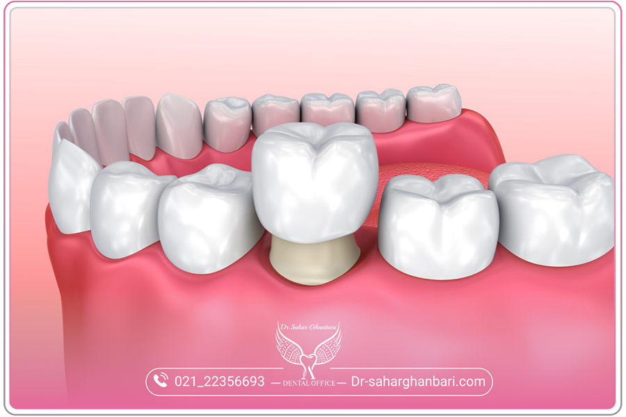 پروتز دندان معایب و مزایا